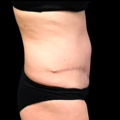 Tummy Tuck Before & After Patient #6161