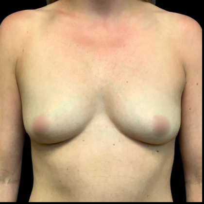 Breast Augmentation Before & After Patient #6264