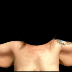 Arm Lift Before & After Patient #6275