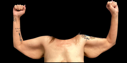 Arm Lift Before & After Patient #6275