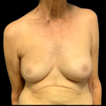 Implant Removal Before & After Patient #6277