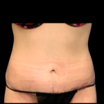Tummy Tuck Before & After Patient #6280