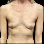 Breast Augmentation Before & After Patient #6265