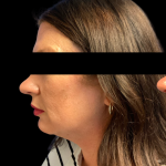 Chin and Neck Liposuction Before & After Patient #6266