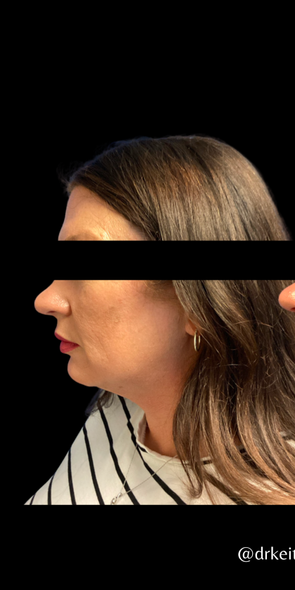 Chin and Neck Liposuction Before & After Patient #6266