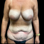 Breast Reduction Before & After Patient #6267