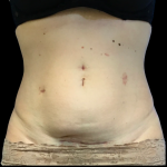 Tummy Tuck Before & After Patient #6268