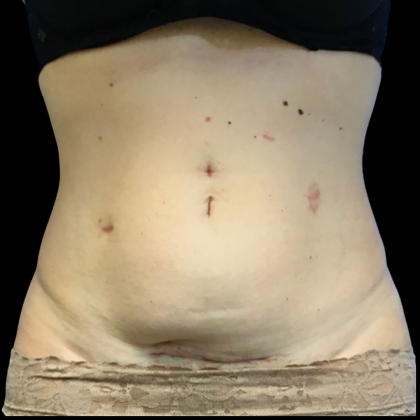 Tummy Tuck Before & After Patient #6268