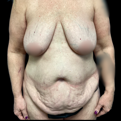 Breast Augmentation Before & After Patient #6269