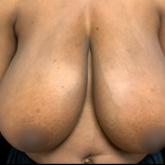 Breast Reduction Before & After Patient #6270