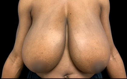 Breast Reduction Before & After Patient #6270
