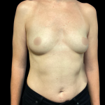 Breast Augmentation Before & After Patient #6272