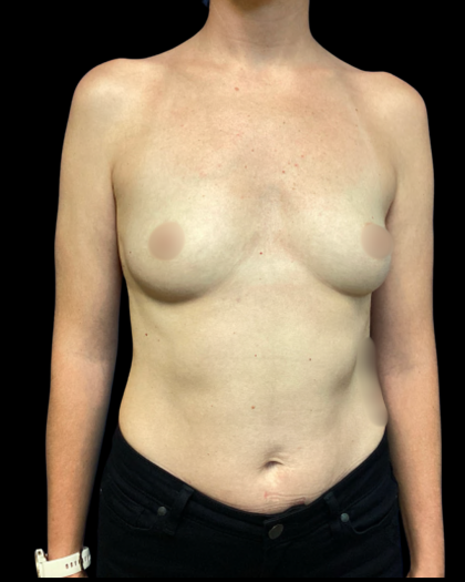 Breast Augmentation Before & After Patient #6272