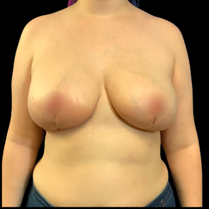 Breast Reduction Before & After Patient #6273