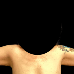 Arm Lift Before & After Patient #6275