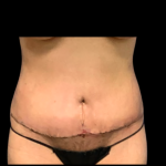 Tummy Tuck Before & After Patient #6280