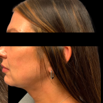 Chin and Neck Liposuction Before & After Patient #6266
