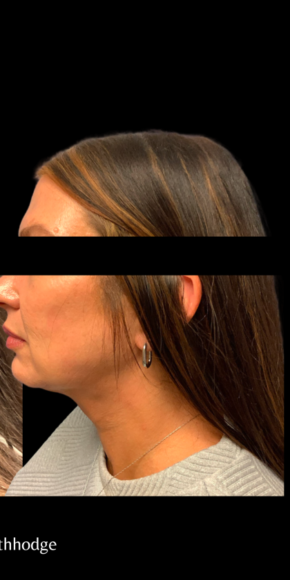 Chin and Neck Liposuction Before & After Patient #6266