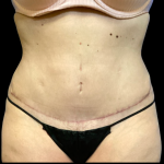 Tummy Tuck Before & After Patient #6268