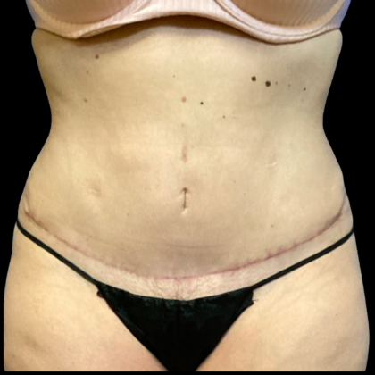 Tummy Tuck Before & After Patient #6268