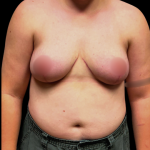 Breast Reduction Before & After Patient #6271