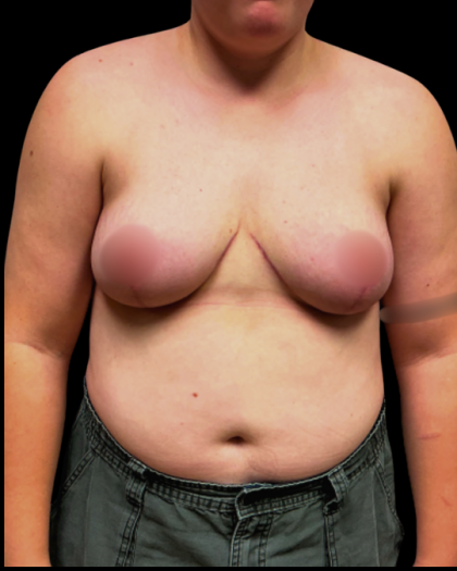 Breast Reduction Before & After Patient #6271