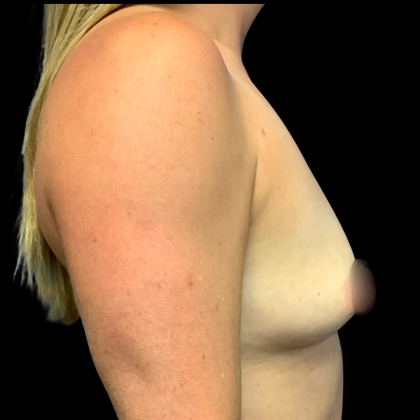 Breast Augmentation Before & After Patient #6264
