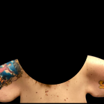 Arm Lift Before & After Patient #6275