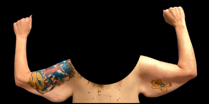 Arm Lift Before & After Patient #6275
