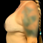 Implant Removal Before & After Patient #6276