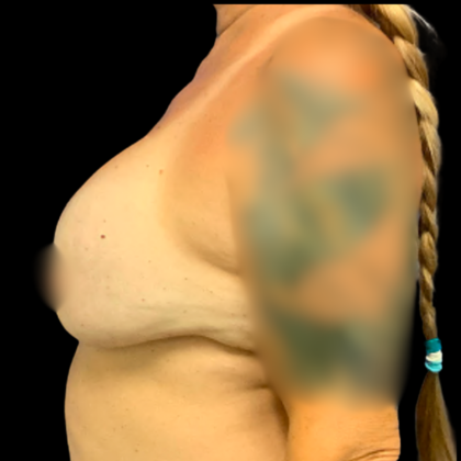 Implant Removal Before & After Patient #6276