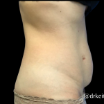Tummy Tuck Before & After Patient #6268