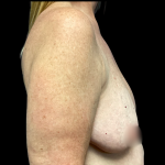 Breast Augmentation Before & After Patient #6269