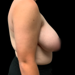 Breast Reduction Before & After Patient #6271