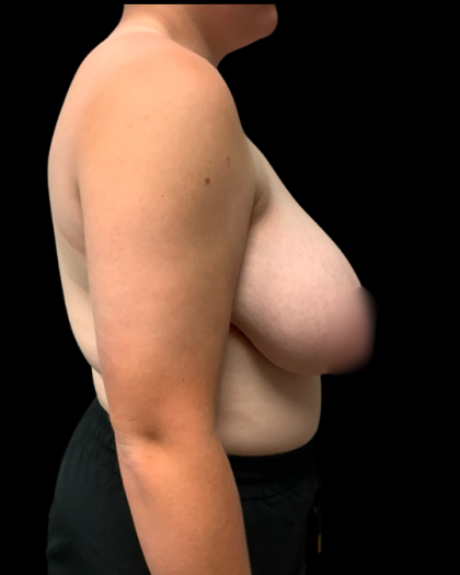 Breast Reduction Before & After Patient #6271