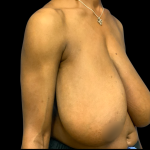 Breast Reduction Before & After Patient #6270