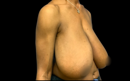 Breast Reduction Before & After Patient #6270