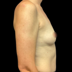 Breast Augmentation Before & After Patient #6272