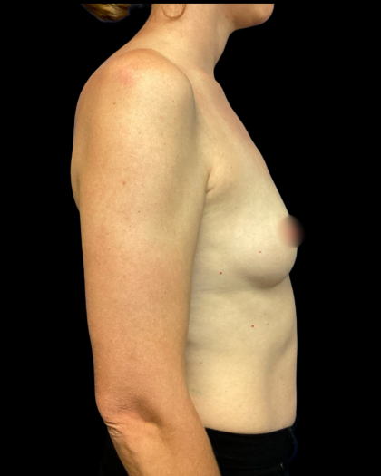 Breast Augmentation Before & After Patient #6272