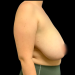 Breast Reduction Before & After Patient #6273