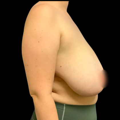 Breast Reduction Before & After Patient #6273