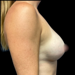 Breast Augmentation Before & After Patient #6264
