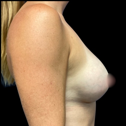Breast Augmentation Before & After Patient #6264