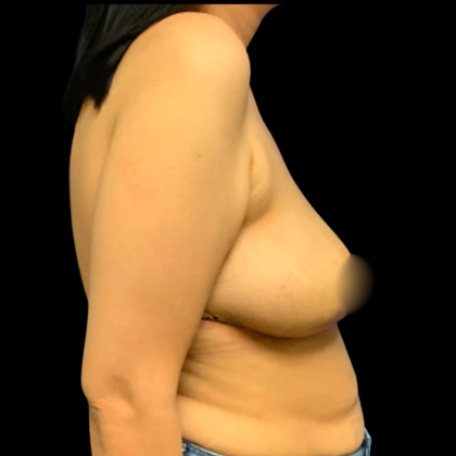 Breast Reduction Before & After Patient #6274