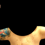 Arm Lift Before & After Patient #6275