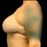 Implant Removal Before & After Patient #6276