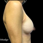 Breast Augmentation Before & After Patient #6265