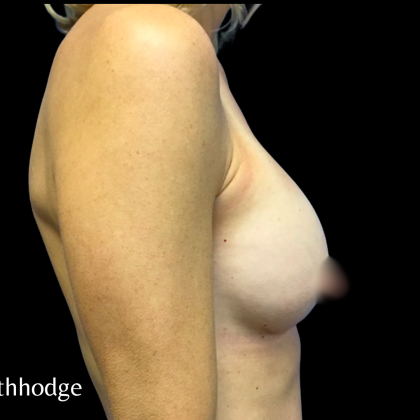 Breast Augmentation Before & After Patient #6265