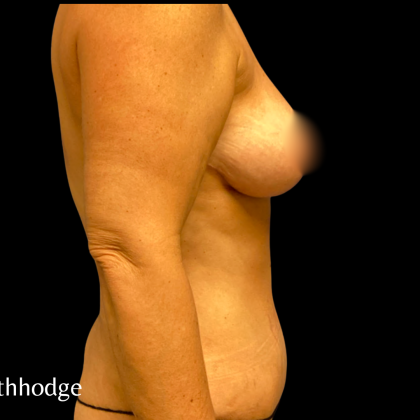 Breast Reduction Before & After Patient #6267