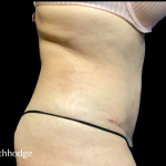 Tummy Tuck Before & After Patient #6268